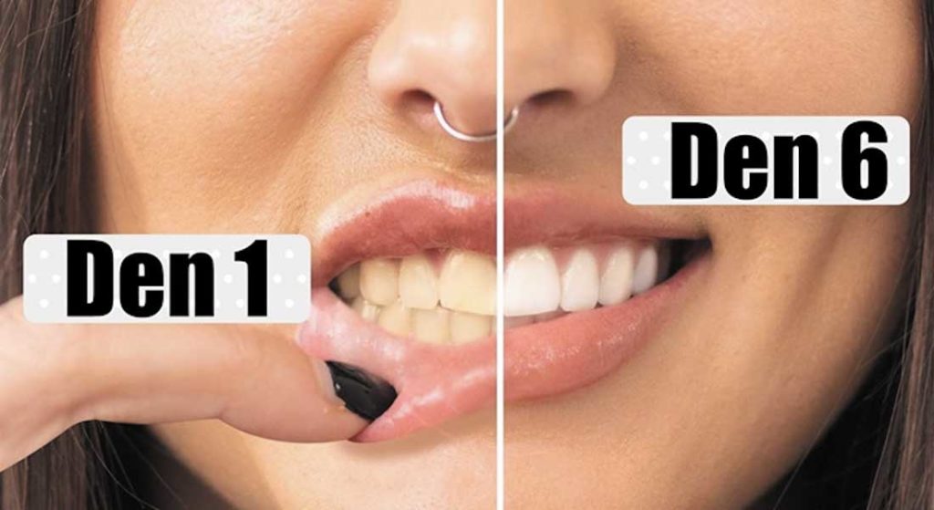 Rozdíly po bělení zubů po 6ti dnech